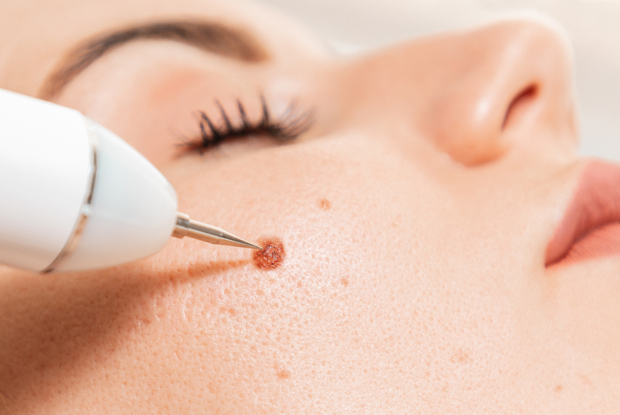 Close-up photograph of a skin lesion being treated.