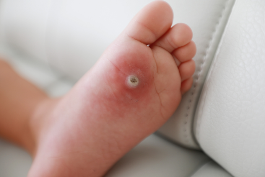 Close-up photograph of a lesion on the sole of a foot.