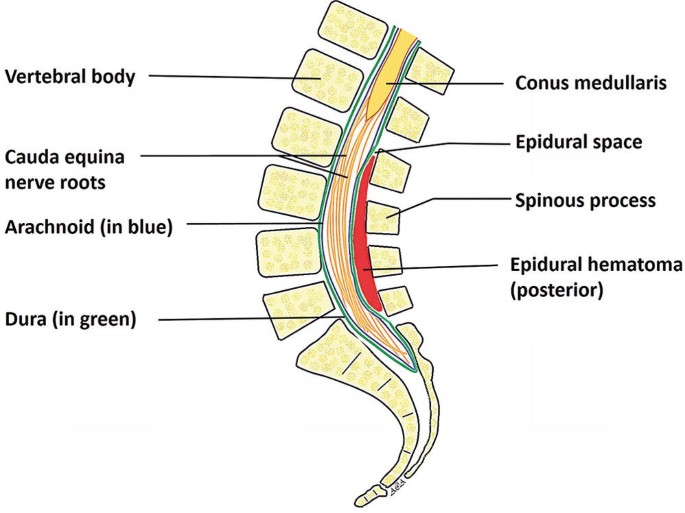 Diagram of a posterior epidural hematoma near the cauda equina.
