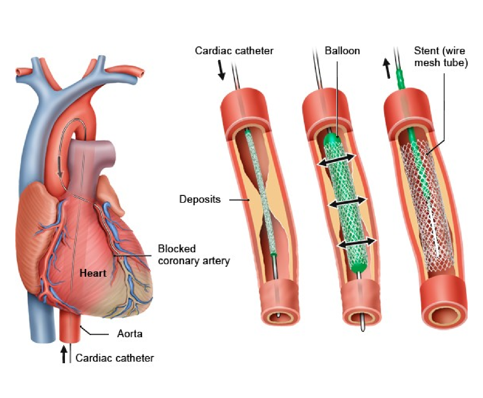 Diagram of catheter placement and stent expansion in a blocked coronary artery.