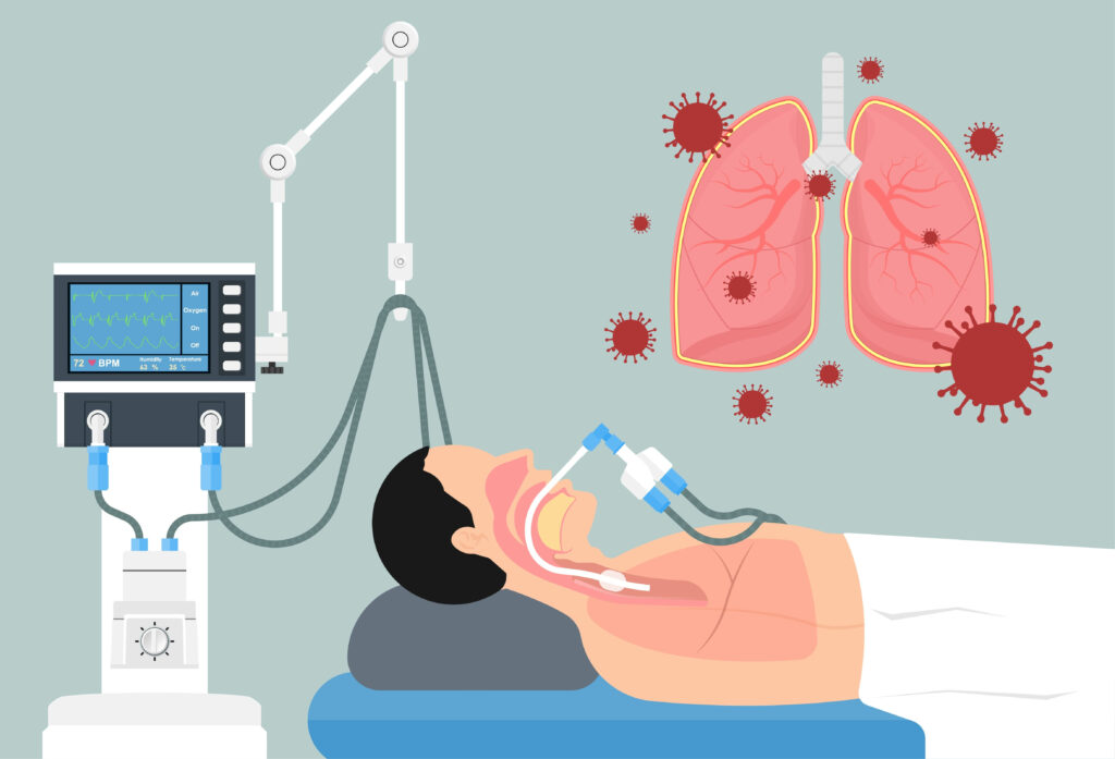 Illustration of a person receiving mechanical ventilation.