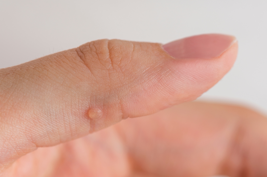 Close-up photograph of a finger with a small lesion.