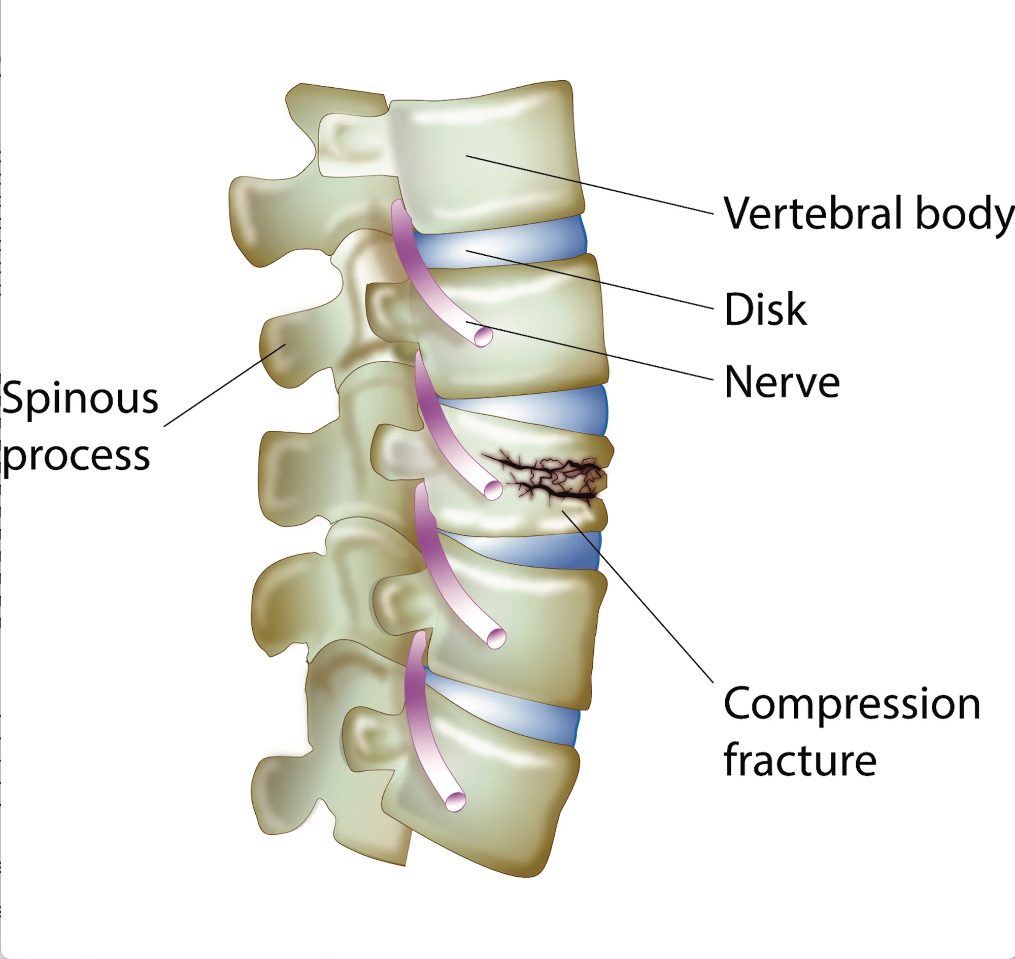 Diagram of a spinal compression fracture.