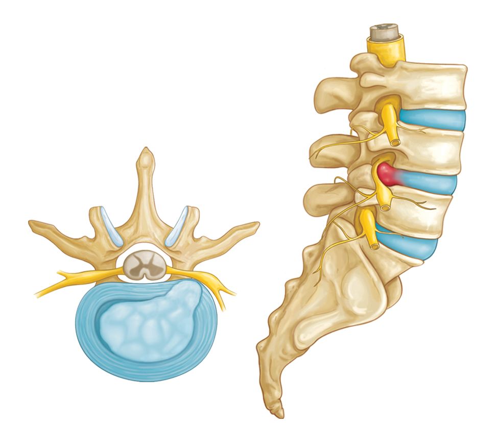 Diagram of a herniated disk beside the spinal nerves.