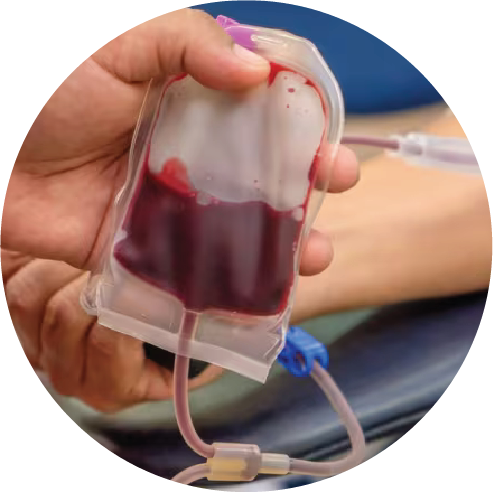 Blood collection bag with tubing.