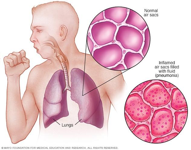 Diagram that compares normal air sacs with inflamed air sacs.