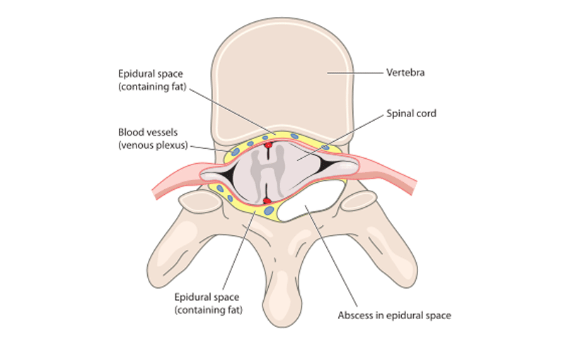 Diagram of an abscess in the spinal epidural space.