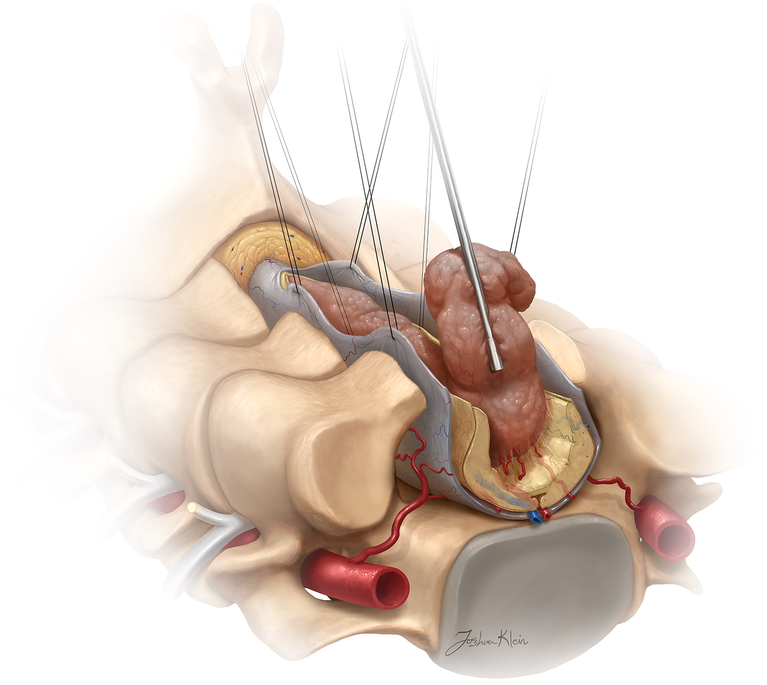 Spinal imaging figure with leader lines.