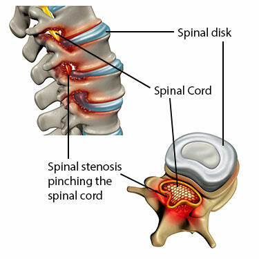 Diagram of spinal stenosis that pinches the spinal cord.